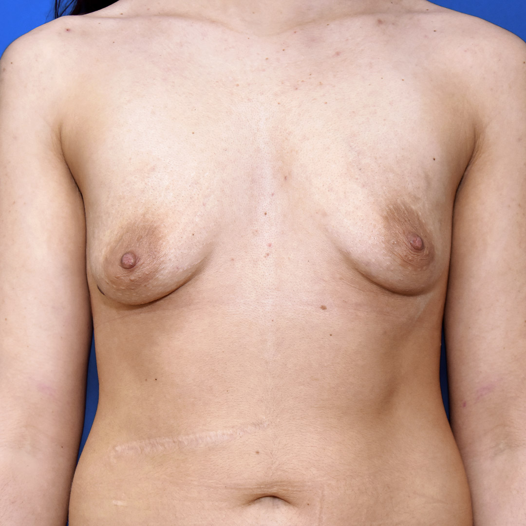 Breast Lift with implant, 26 Vorher Nachher