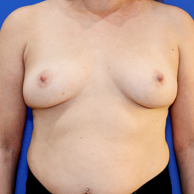 Breast Augmentation, 44