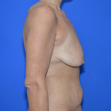 Breast Lift with implant, 33
