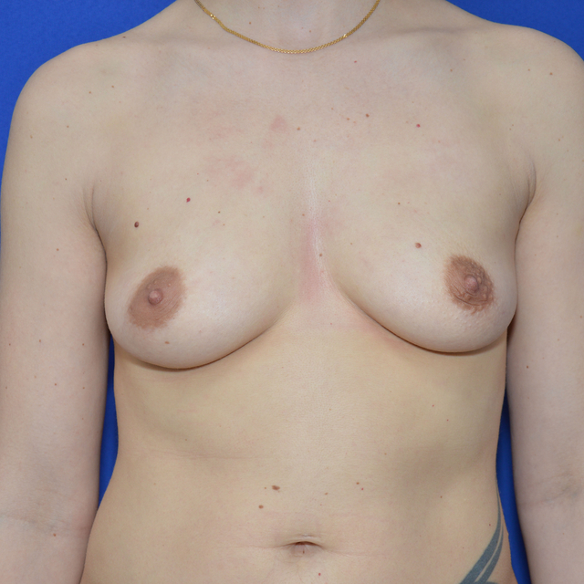 Breast Lift with implant, 32