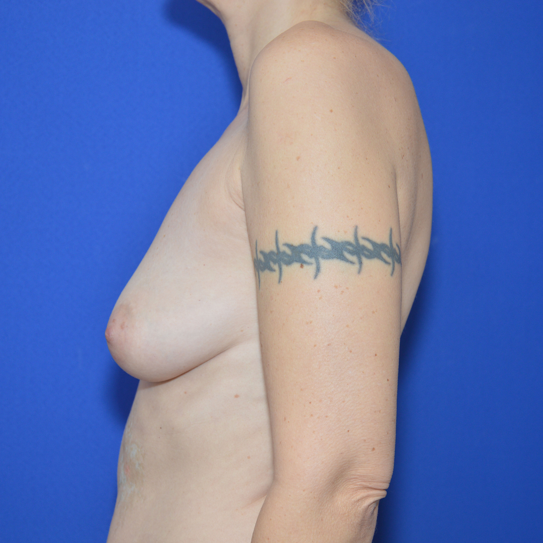Breast Lift with implant, 48 Vorher Nachher