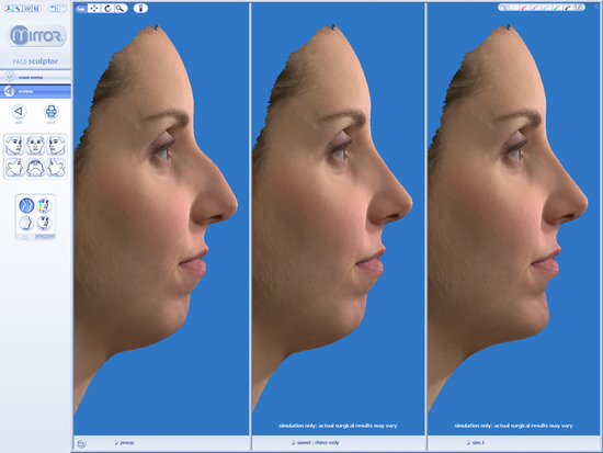 3D Simulation einer Nasenkorrektur