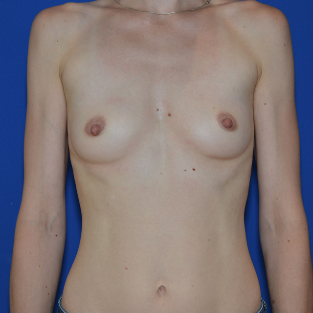Breast Augmentation, 37