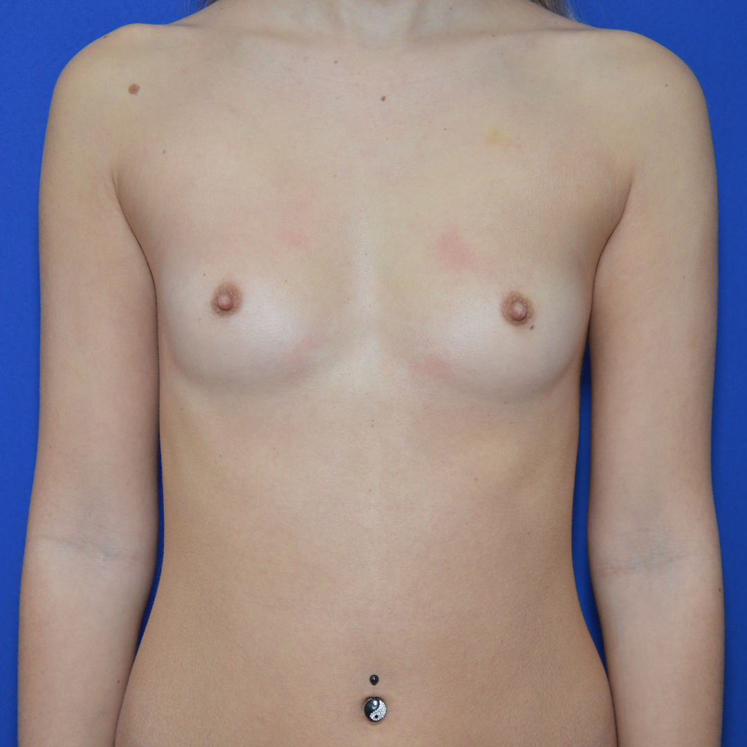 Breast Augmentation, 23 Vorher Nachher