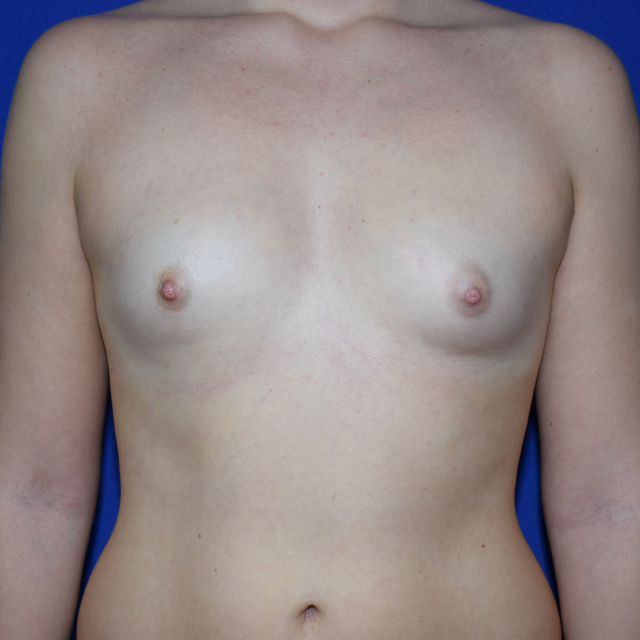 Breast Augmentation, 25