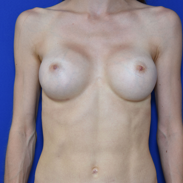 Breast Augmentation, 24