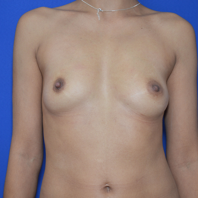 Breast Augmentation, 34