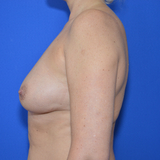 Breast Lift with implant, 49