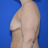 Breast Lift with implant, 45