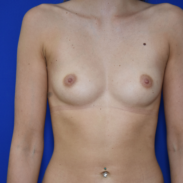 Breast Augmentation, 23