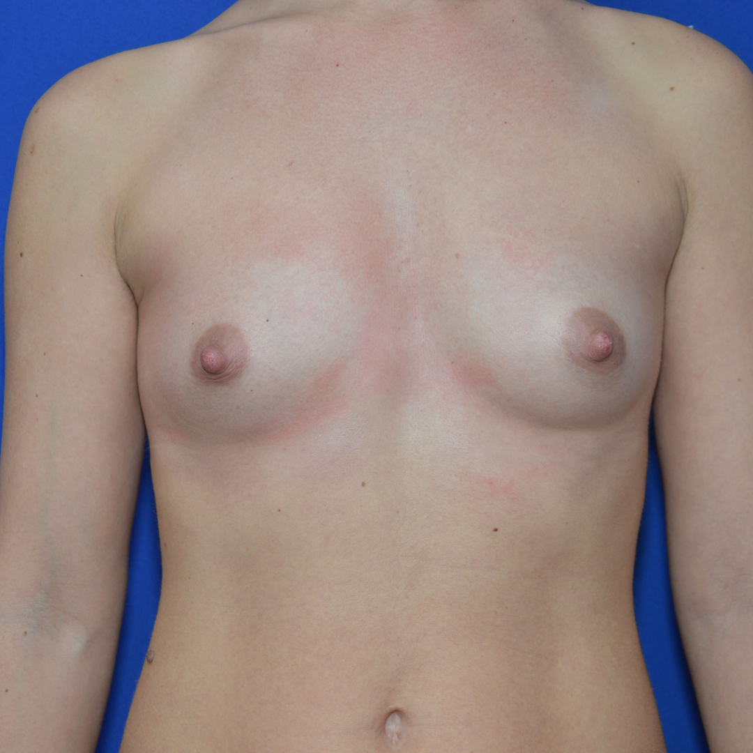 Breast Augmentation, 36 Vorher Nachher