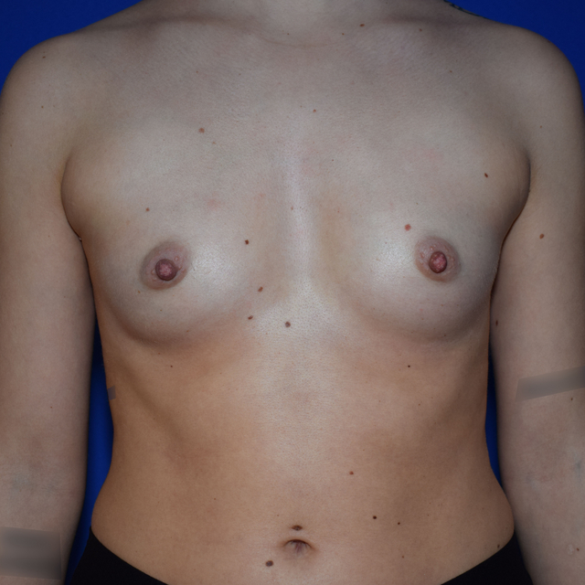 Breast Augmentation, 27
