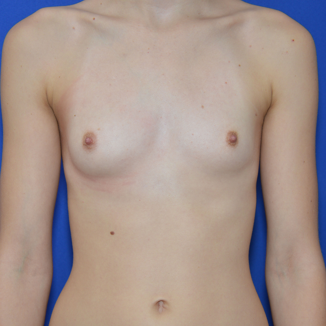 Breast Augmentation, 25 Vorher Nachher