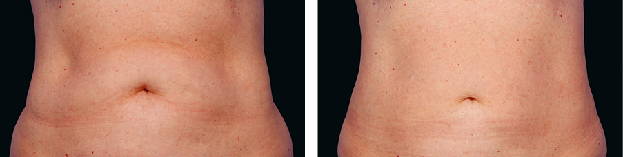 Coolsculpting Before & After