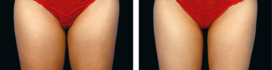 Coolsculpting Before & After
