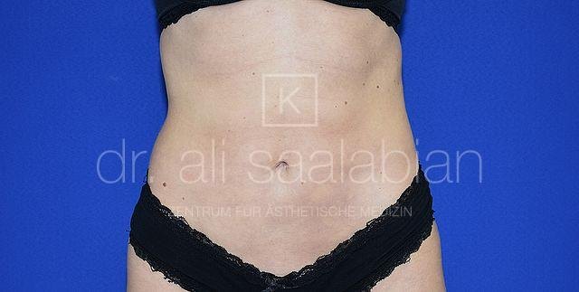Liposuction abdomen and flanks, case 22536, after surgery – Kuzbari Centre Vienna
