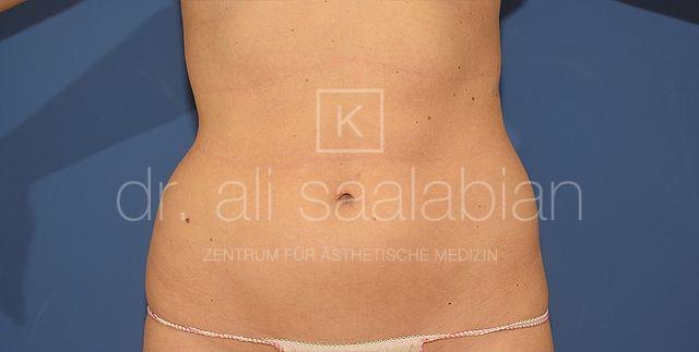 Liposuction abdomen and flanks, case 22536, before surgery – Kuzbari Centre Vienna