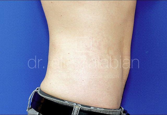 Liposuction abdomen and flanks, case 15846, after surgery – Kuzbari Centre Vienna