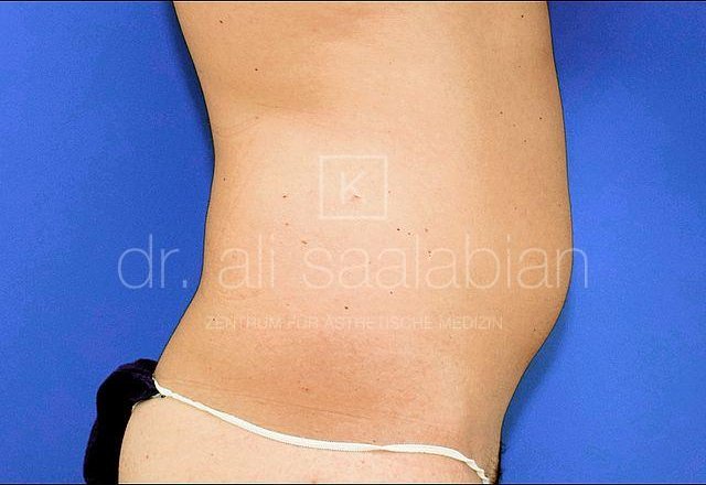 Liposuction abdomen and flanks, case 15846, before surgery – Kuzbari Centre Vienna