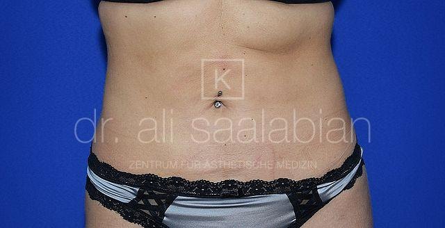 Liposuction abdomen and flanks, case 24213, after surgery – Kuzbari Centre Vienna