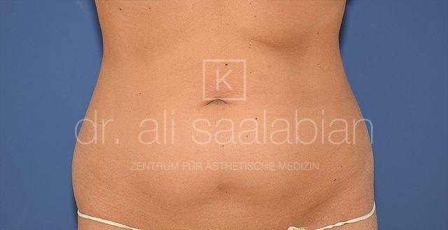 Liposuction abdomen and flanks, case 24213, before surgery – Kuzbari Centre Vienna