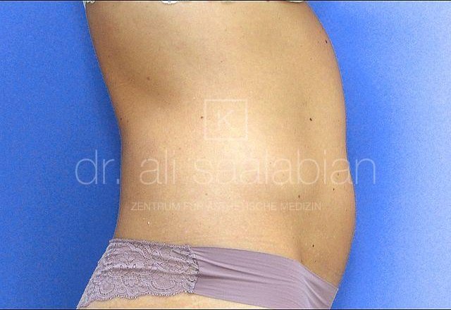 Liposuction hips, flanks, abdomen, case 9210, before surgery – Kuzbari Centre Vienna