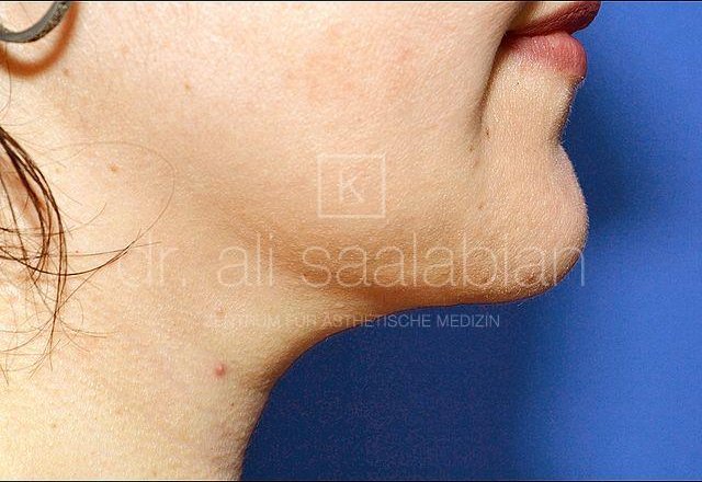 Liposuction neck and chin, case 8116, after surgery – Kuzbari Centre Vienna