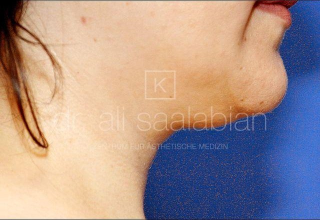 Liposuction neck and chin, case 8116, before surgery – Kuzbari Centre Vienna