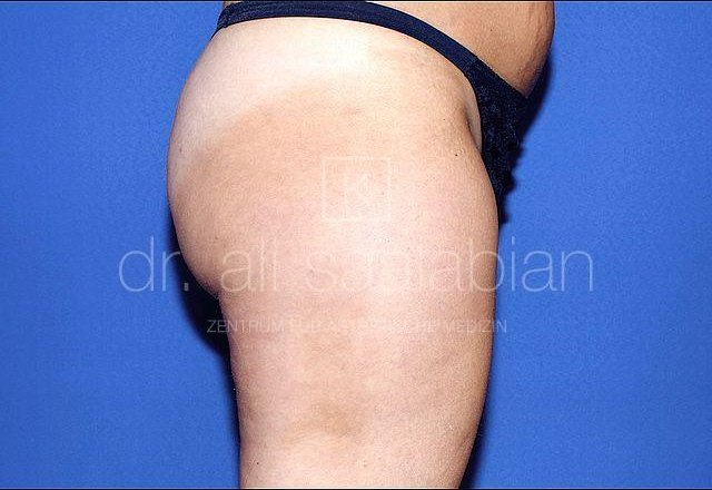 Liposuction thighs and buttocks, case 9320, after surgery – Kuzbari Centre Vienna