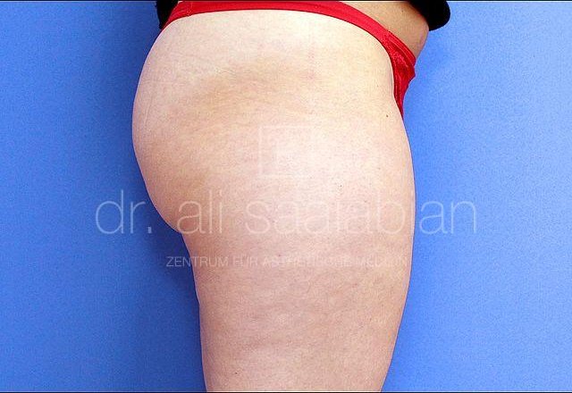 Liposuction thighs and buttocks, case 9320, before surgery – Kuzbari Centre Vienna