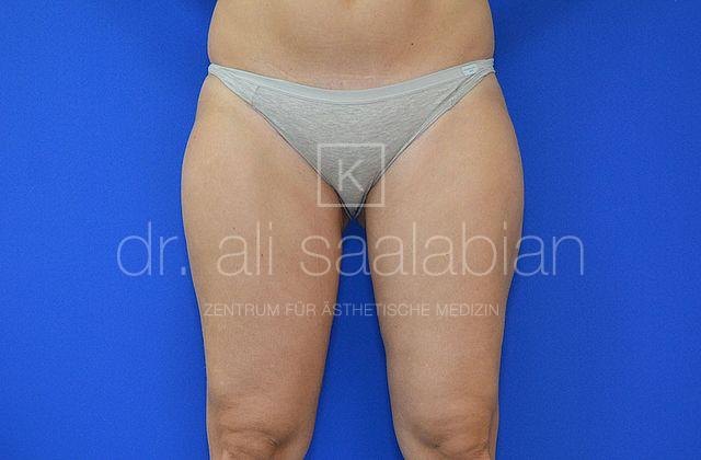 Liposuction thighs and flanks, case 16386, after surgery – Kuzbari Centre Vienna