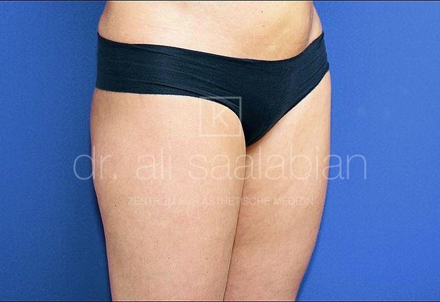 Liposuction thighs, abdomen, flanks, case 17636, after surgery – Kuzbari Centre Vienna