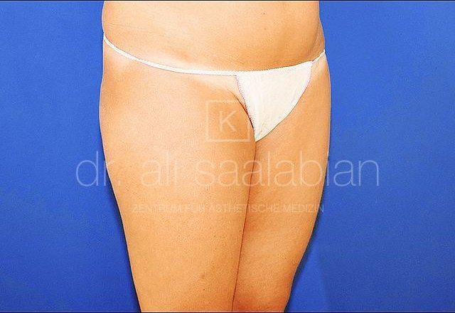Liposuction thighs, abdomen, flanks, case 17636, before surgery – Kuzbari Centre Vienna