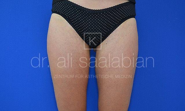 Liposuction inner thighs, case 19390, after surgery – Kuzbari Centre Vienna