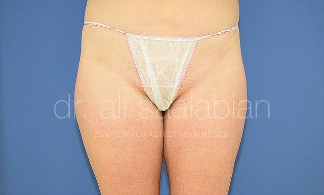 Liposuction inner thighs, case 19390, before surgery – Kuzbari Centre Vienna
