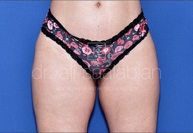 Liposuction saddlebags, case 17133, after surgery – Kuzbari Centre Vienna