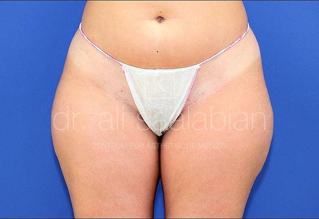 Liposuction saddlebags, case 17133, before surgery – Kuzbari Centre Vienna