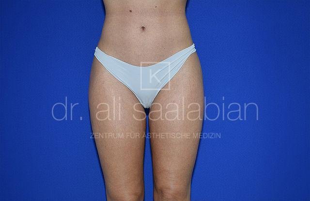 Liposuction saddlebags and hips, case 24694, after surgery – Kuzbari Centre Vienna