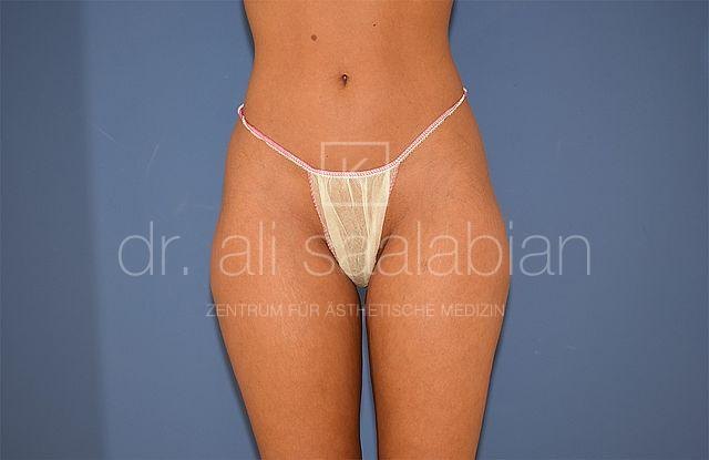 Liposuction saddlebags and hips, case 24694, before surgery – Kuzbari Centre Vienna