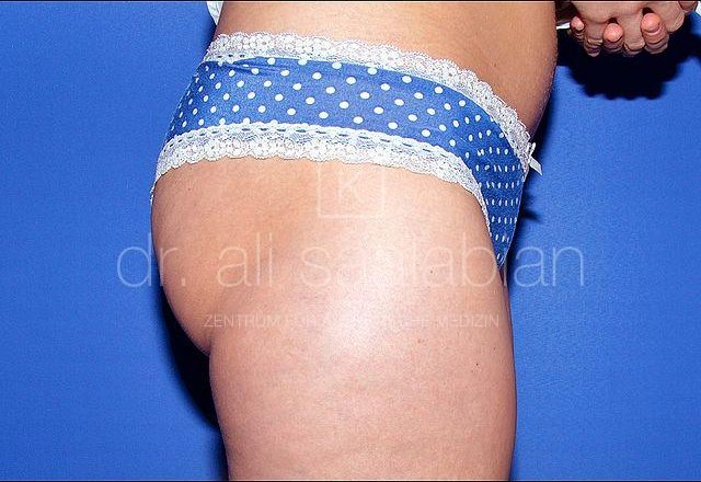 Liposuction saddlebags, case 7147, before surgery – Kuzbari Centre Vienna