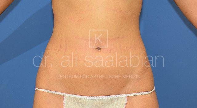 Liposuction lower abdomen, case 20187, before surgery – Kuzbari Centre Vienna