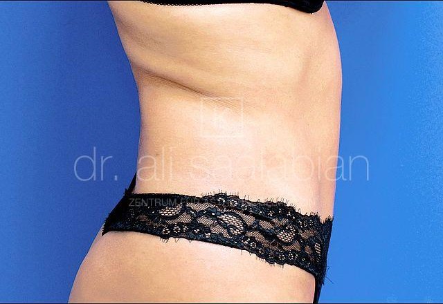 Liposuction lower abdomen, case 18097, after surgery – Kuzbari Centre Vienna