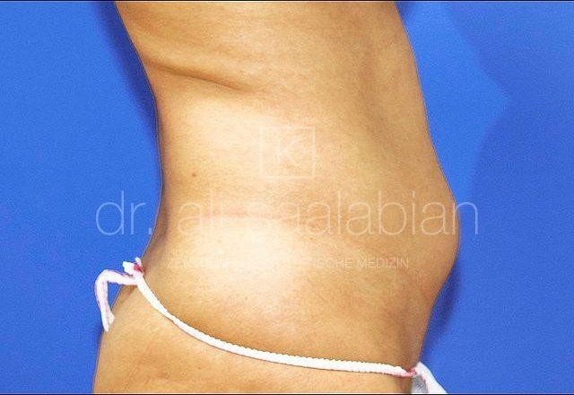 Liposuction lower abdomen, case 18097, before surgery – Kuzbari Centre Vienna