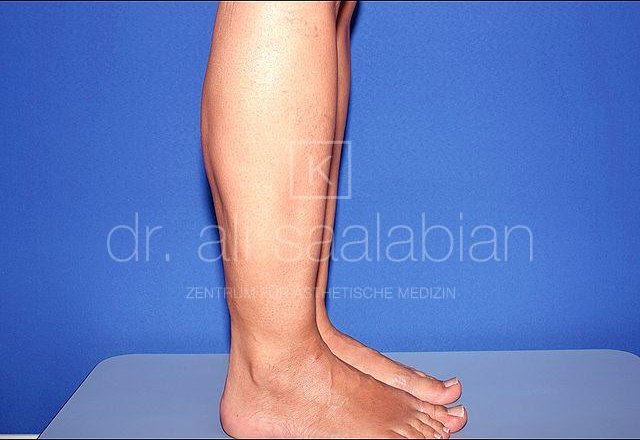 Liposuction lower legs, lipoedema, case 7480, after surgery – Kuzbari Centre Vienna