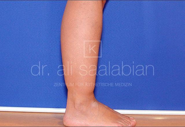 Liposuction lower legs, lipoedema, case 7480, before surgery – Kuzbari Centre Vienna