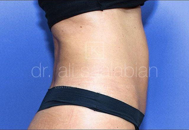 Fettabsaugung Flanken, Bauch, Po, Fall 9545, nach der Operation – Kuzbari Zentrum Wien