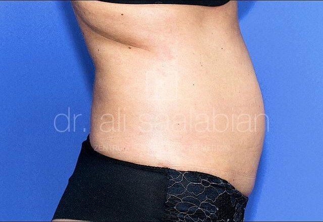 Fettabsaugung Flanken, Bauch, Po, Fall 9545, vor der Operation – Kuzbari Zentrum Wien