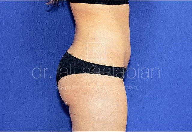 Liposuction abdomen, flanks, buttocks, case 5619, after surgery – Kuzbari Centre Vienna