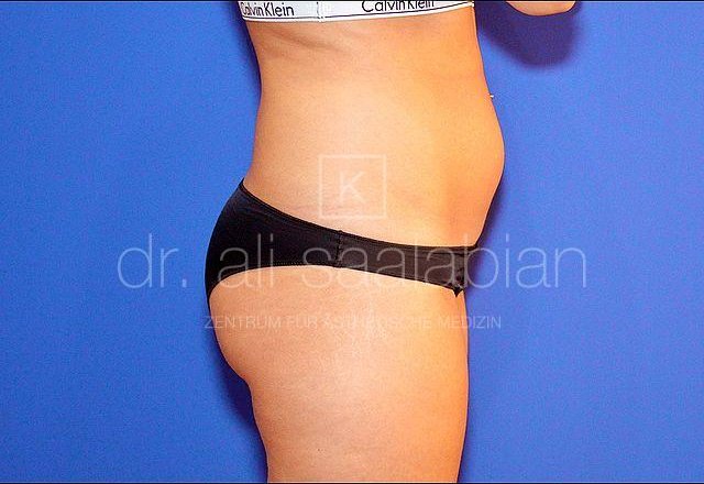 Liposuction abdomen, flanks, buttocks, case 5619, before surgery – Kuzbari Centre Vienna