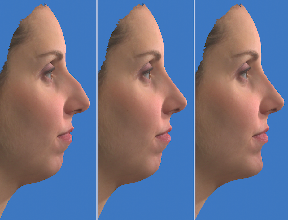 3D Simulation einer Nasenkorrektur